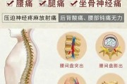 腰间盘突出治疗方法：有效缓解疼痛、预防复发