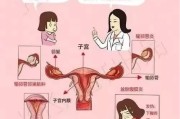 盆腔粘连：对女性健康的影响及预防措施