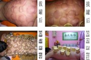 拔火罐减肥：舒适疗法助你瘦身健康