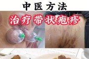 蛇盘疮最佳治疗方法——缓解疼痛、促进恢复的有效措施