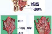 喉癌症状-了解喉癌的常见症状和表现