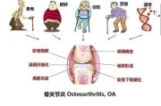 退行性关节炎：病因、症状与治疗