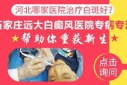 保定白癜风专科医院：提供专业治疗白癜风的专家服务