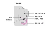 乳腺癌早期症状图片：如何及早发现乳腺癌