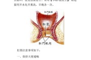 肛裂的症状及治疗方法