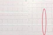 探索T波改变：异常心电图所言不语