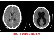 脑积水症状揭秘：了解病情更早预防治疗