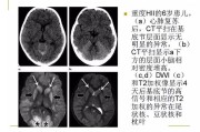 缺氧缺血性脑病：致命的脑部损伤