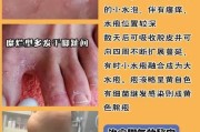 水泡型脚气的治疗方法