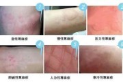 荨麻疹症状：了解、预防和治疗的综述