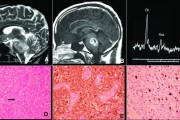 脑干胶质瘤发病原因及相关机制研究