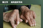 了解类风湿性关节炎对身体的影响与预防