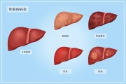 肝硬化的症状及治疗方法