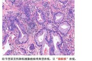 粘液腺癌：症状、诊断与治疗