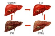 原发性肝癌晚期症状：了解晚期肝癌所带来的身体变化