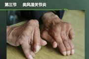 风湿关节炎：原因、症状和治疗措施