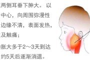 腮腺炎症状：了解腮腺炎的常见症状