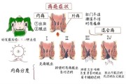 痔疮症状大揭秘：了解痔疮的常见症状