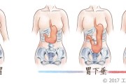 胃下垂的症状及其相关信息