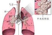 肺癌：病因与治疗手段的深入探讨