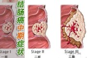 结肠癌的症状及治疗