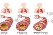 支气管哮喘症状：了解症状与寻求及时治疗的重要性