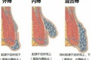 早期症状预示着痔疮疾病的蔓延