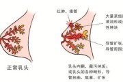 乳腺炎早期症状揭秘！