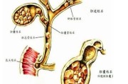 胆结石最佳治疗方法：选用手术或药物？