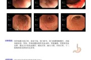 贲门癌症状及其相关信息