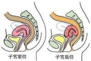 子宫移位的症状有哪些？