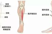 小腿骨膜炎的症状：了解症状及预防方法