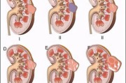 肾囊肿的形成原因及机制探析