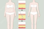 抽脂减肥方法：科学瘦身有效又安全