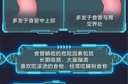 食道癌病因：患病与日常生活习惯息息相关