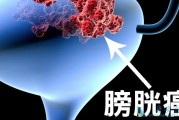 膀胱癌症状：了解病情及早预防，保护健康