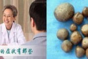 前列腺结石治疗方法：从根源解决问题