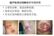 肉芽肿性乳腺炎：症状、治疗及预防