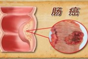 直肠癌早期的5大症状及预防方法