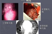 肺大泡是什么病？了解肺大泡的症状、原因和治疗方法