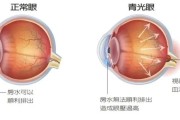 青光眼最佳治疗方法：保护视力，缓解病情