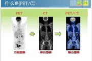 什么是PET CT检查？