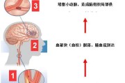 脑血栓形成原因分析-了解致病原因的重要性