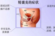 精囊炎症状诊断及治疗方法介绍