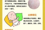 痱子症状分析与预防措施