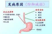 胃食管反流病症状及其治疗