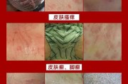 阴囊湿疹症状图片解析：如何识别和治疗阴囊湿疹症状