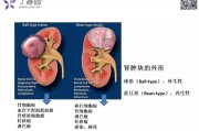 肾脏肿瘤：病因、症状及治疗方法解析