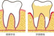 磨牙的治疗方法：预防和治疗的最佳策略