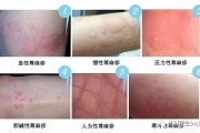 人工性荨麻疹症状-了解、预防与治疗